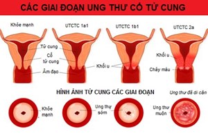 Những điều cần biết về phòng ngừa ung thư cổ tử cung