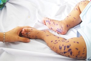 4 lưu ý khi chăm sóc thủy đậu tại nhà, tránh biến chứng