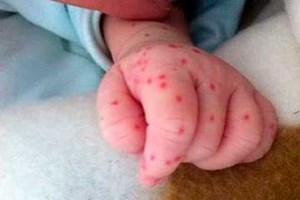 Nóng ẩm, mưa nhiều, coi chừng dịch sốt xuất huyết bùng phát