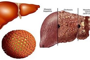 Hỏng gần hết gan thận chỉ vì uống nấm linh chi chữa bệnh