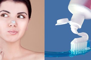 Đang bị mụn cần tránh làm 5 việc này để không làm tình trạng mụn thêm tồi tệ