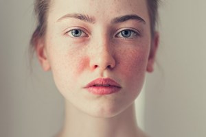 8 loại mụn trên da chớ có nặn