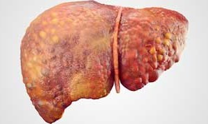 Cứ 10 người bị ung thư gan thì có 8 người do tiến triển từ viêm gan virus B