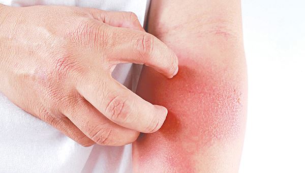 Viêm da cơ địa khi trời nồm, chữa thế nào?