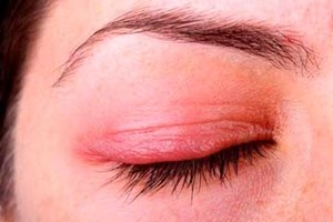 Chọn thuốc gì khi viêm bờ mi?