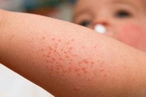 Dịch bệnh tay chân miệng, sởi, sốt xuất huyết chưa qua, nguy cơ bệnh mới đã đến