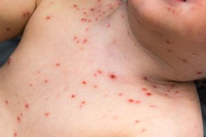 5 thực phẩm nên tránh ăn khi mắc thủy đậu
