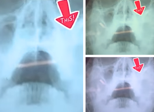 Khám sức khỏe tổng quát phát hiện đa bệnh - Anh Hà sinh năm 1979 quận 12