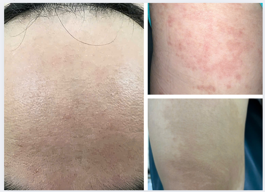 Khám sức khỏe tổng quát phát hiện bệnh nhiễm ký sinh trùng - bệnh nhân Anh Trung sinh năm 1994 tại Gò Vấp