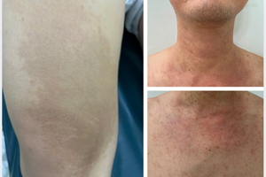 Khám sức khỏe tổng quát phát hiện bệnh sán chó - Anh Thu sinh năm 1994 tại Quận 12